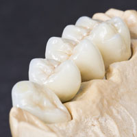 Zahnarzt Zinn Gießen Hochwertiger Zahnersatz